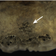 Pits on the skull are potential evidence of a tumor that caused impaired function of the pituitary gland.